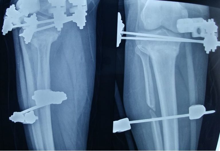 Osteotomy non-union – Orthopaedic Complications